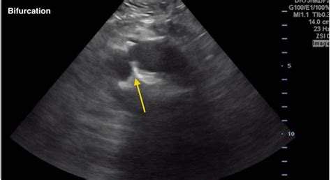 Internal Iliac Artery Ultrasound