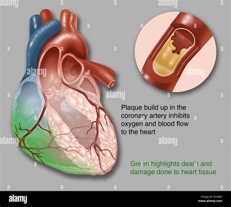 llustration showing acute heart failure. Plaque build-up in the coronary artery inhibits oxygen ...