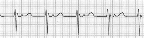 Accelerated Junctional Rhythm (AJR) • LITFL • ECG Library Diagnosis