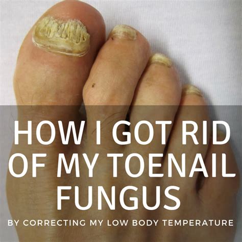 How I Cured My Toenail Fungus (Onychomycosis) | Patient's Lounge