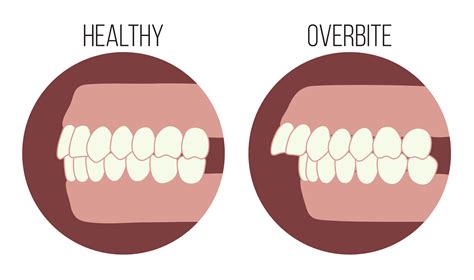 Overbite or "Buck Teeth": THE STEPS TO THE SMILE YOU'VE ALWAYS WANTED - Sherman & Balhoff ...