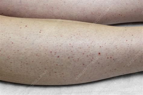 Henoch-Schonlein purpura rash - Stock Image C021/5600 - Science Photo Library