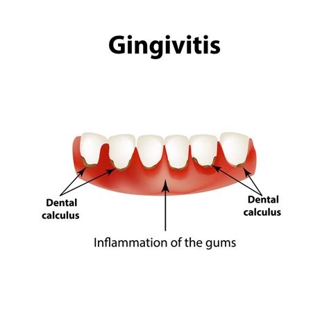 Gingivitis - Forest & Ray - Dentists, Orthodontists, Implant Surgeons