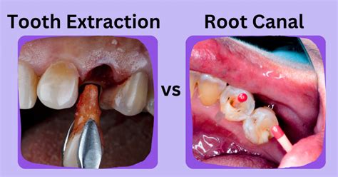 Comparing Tooth Extraction vs Root Canal: What's the Difference? | Sri ...