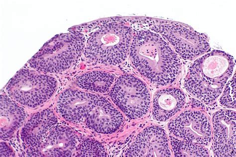 Cystitis cystica - Libre Pathology