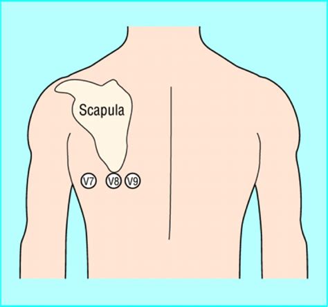 Posterior MI - #ECGclass case 29 (With images) | Ekg placement, Ekg ...