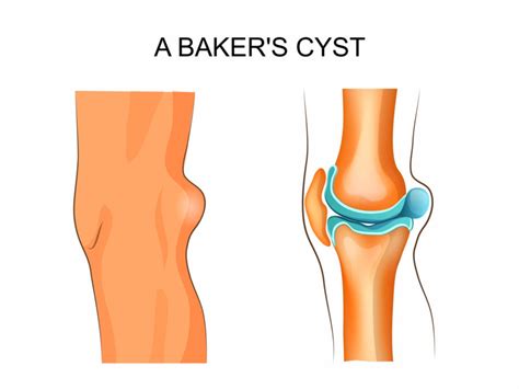 Baker’s Cyst, Causes and Treatment | Direct Orthopedic Care