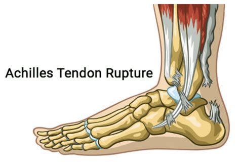 Achilles Tendon Rupture: Orthopedic Center for Sports Medicine: Sports ...