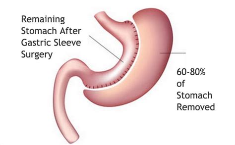 Gastric Sleeve Surgery: The fastest growing bariatric surgery procedure