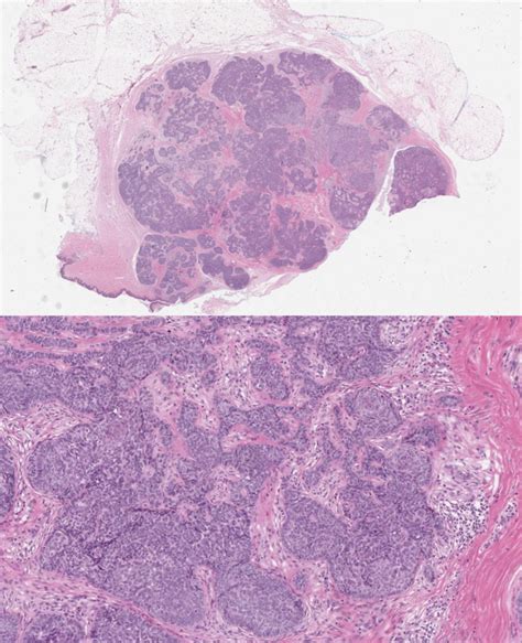 [Figure, Trichoblastoma path Contributed by Nishad Sathe, MD ...