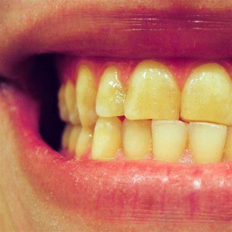 YELLOWISH TEETH TREATMENT: 5 Ways To Whiten Yellowish Teeth