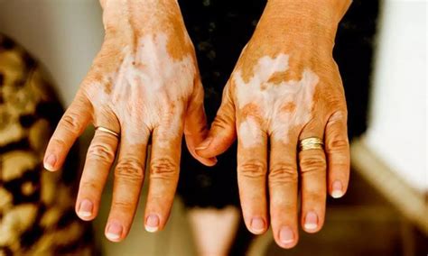 Topical tacrolimus effective preventive therapy in patients with unstable acral vitiligo