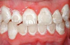 My Braces Doctor | Decalcification Information in Alexandria