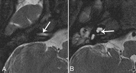 CHARGE syndrome with complete vestibulocochlear nerve aplasia. MRI with...