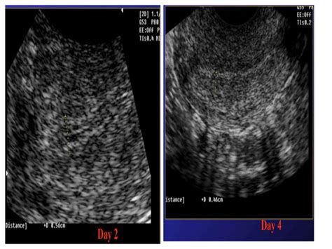 What is uterus Layers of Uterus and 2.pptx