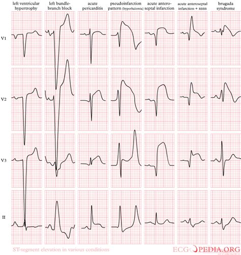 File:Pathologic ST elevation.png - ECGpedia