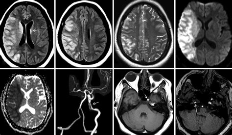 MRI after stroke onset. (a, b) Axial FLAIR and (c) Axial T2-weighted... | Download Scientific ...