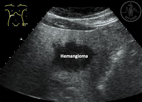 Focal Liver Lesions – Chapter 13.2 Media Library – WFUMB