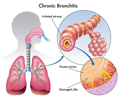 What Is a Lung Infection? (with pictures)