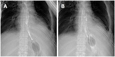 Esophageal Stent X Ray