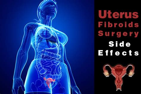 Uterus Fibroids Surgery Side Effects - Uterine Fibroid Surgery