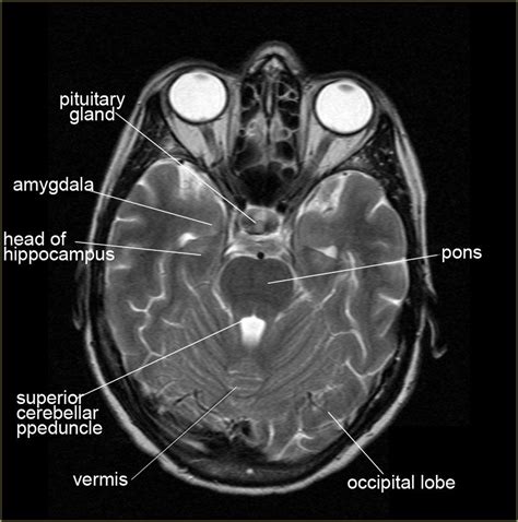 Axial anatomy brain | Brain anatomy, Mri brain, Radiology