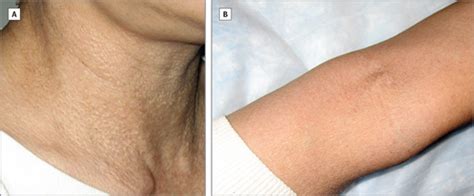 Primary Systemic (Amyloid Light-Chain) Amyloidosis Masquerading as Pseudoxanthoma Elasticum ...