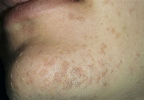 Flat Warts: Symptoms, Causes, and Ways of Treatment - Med Warts