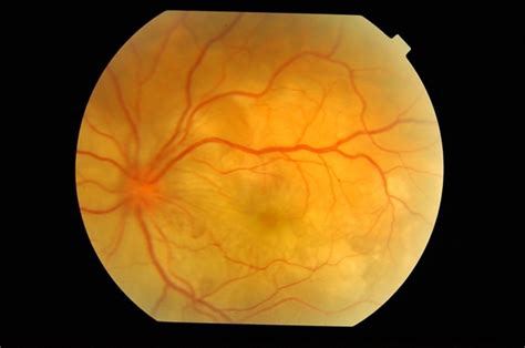 Multifocal Choroiditis - Retina Image Bank