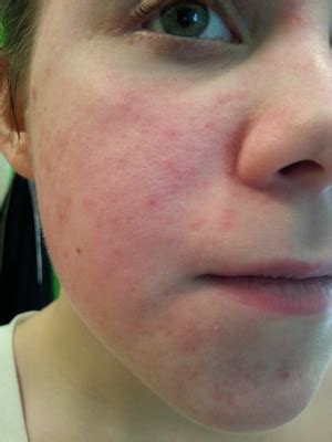 Allergic Reaction To Makeup Brush - Makeup Vidalondon