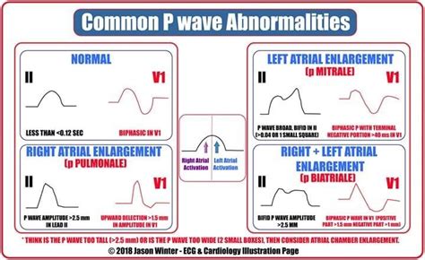 P Wave, Nursing Study, Nurse Stuff, Ekg, Cardiology, Abnormal, Cardiac, Medical, Activities