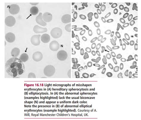 Hereditary Elliptocytosis and Spherocytosis: Diagnosis and treatment