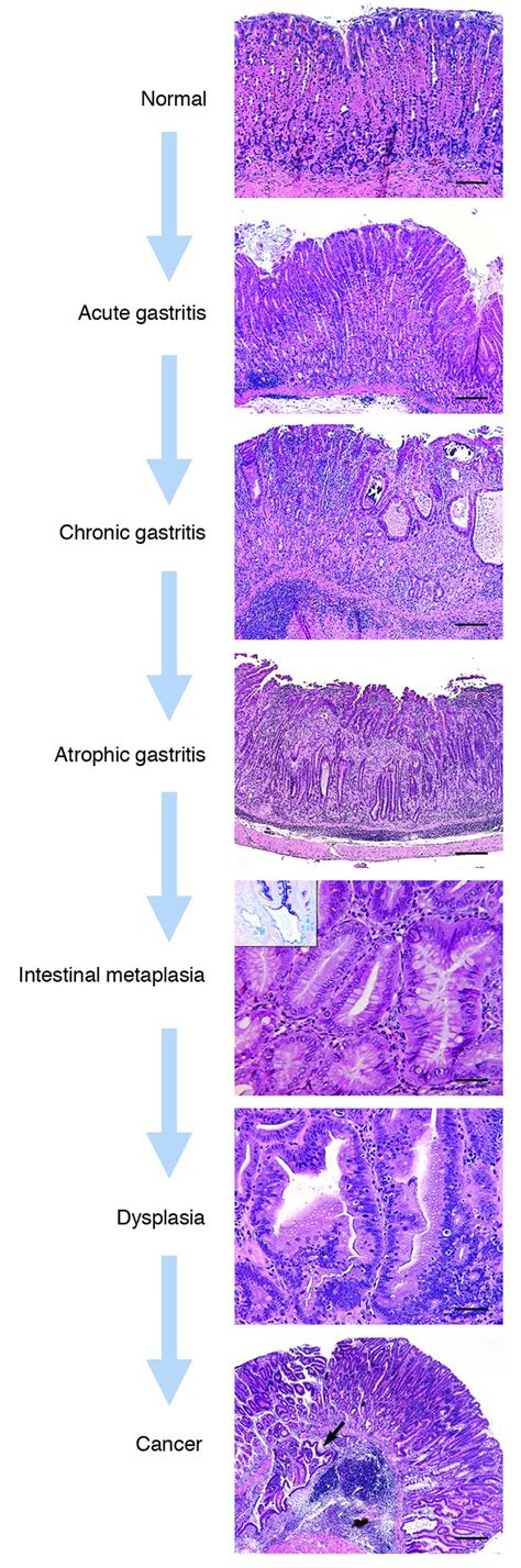 JCI - Inflammation, atrophy, and gastric cancer