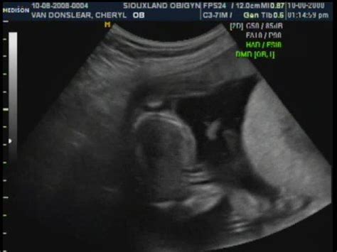 19 week Baby Boy Ultrasound - YouTube