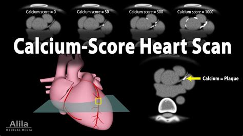 Calcium Score Heart Scan, Animation - YouTube