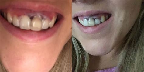 Woman Shares Photos of Bad Teeth-Whitening Job That Burned Her Gums