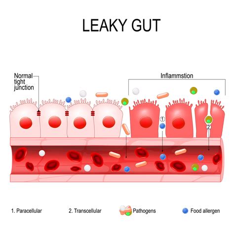 Can Leaky Gut Lead to Autoimmune Condition? - Gut Authority