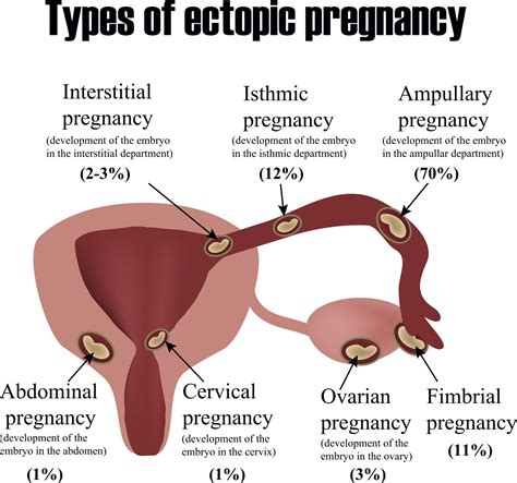 Symptoms Ectopic Pregnancy