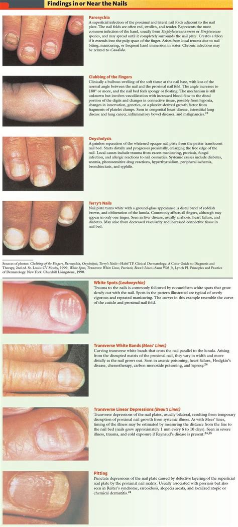 View in full resolution Nail Fungus Remedy, Toenail Fungus, Nail ...