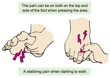 Pain between first and second metatarsal bones | KASAHARA FOOT CARE