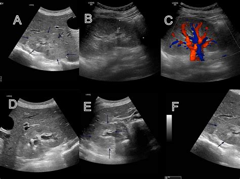 Pyelonephritis in Pregnancy From the Lens of an Underserved Community ...