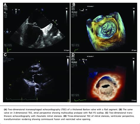 Transesophageal Echocardiography of a Barlow Mitral Valve and Rheumatic ...