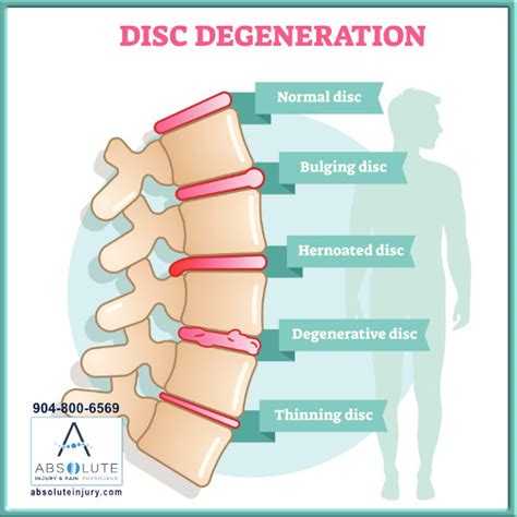 Types of Disc Injuries – Absolute Injury and Pain Physicians