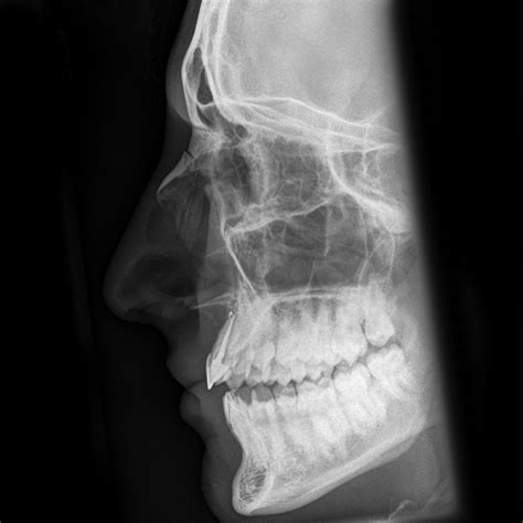 Xray broken nose | Broken nose, Human body anatomy, Bone fracture