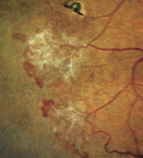 Diagnostic and Treatment Update on Sickle Cell Retinopathy - Advances ...