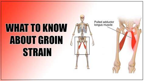 Expert Physical Therapy Guide to Recover Groin Strain – Oklahoma Physical Therapy