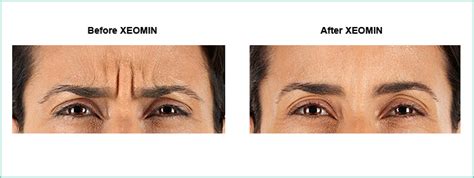 XEOMIN® | Frown Line Treatment | Virginia Surgical Arts