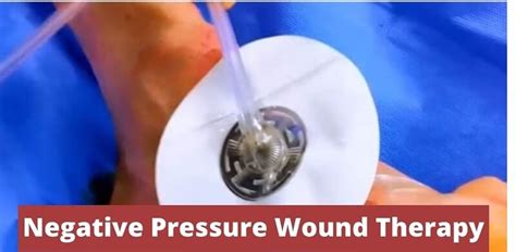 Wound VAC Therapy Or Negative Pressure Wound Therapy - WCS