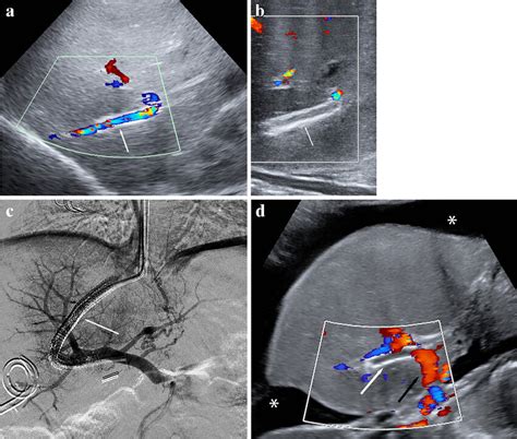 Ascites relapse and stent re-thrombosis in a 5-month-old girl with ...