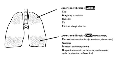 Pulmonary fibrosis | OSCEstop | OSCE Learning